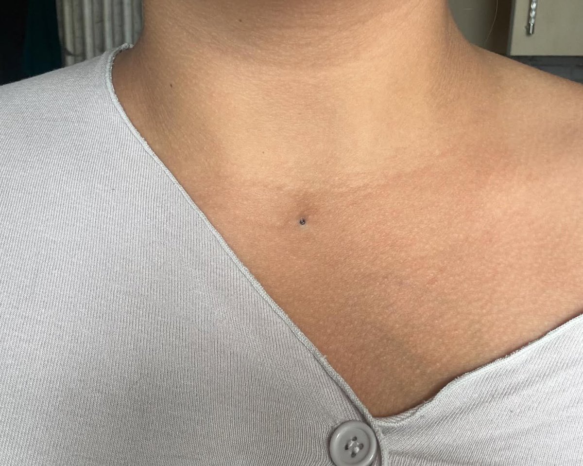 yankeedraft's tweet photo. Maybe this post will reach someone who knows and can help.

Almost 2 years ago, my girlfriend had a microneedling treatment. Now her skin seems to be reacting to it. She doesn't want to have it removed. Is there anything that can be done about this? 🥲 https://t.co/Yrq4m0UFId