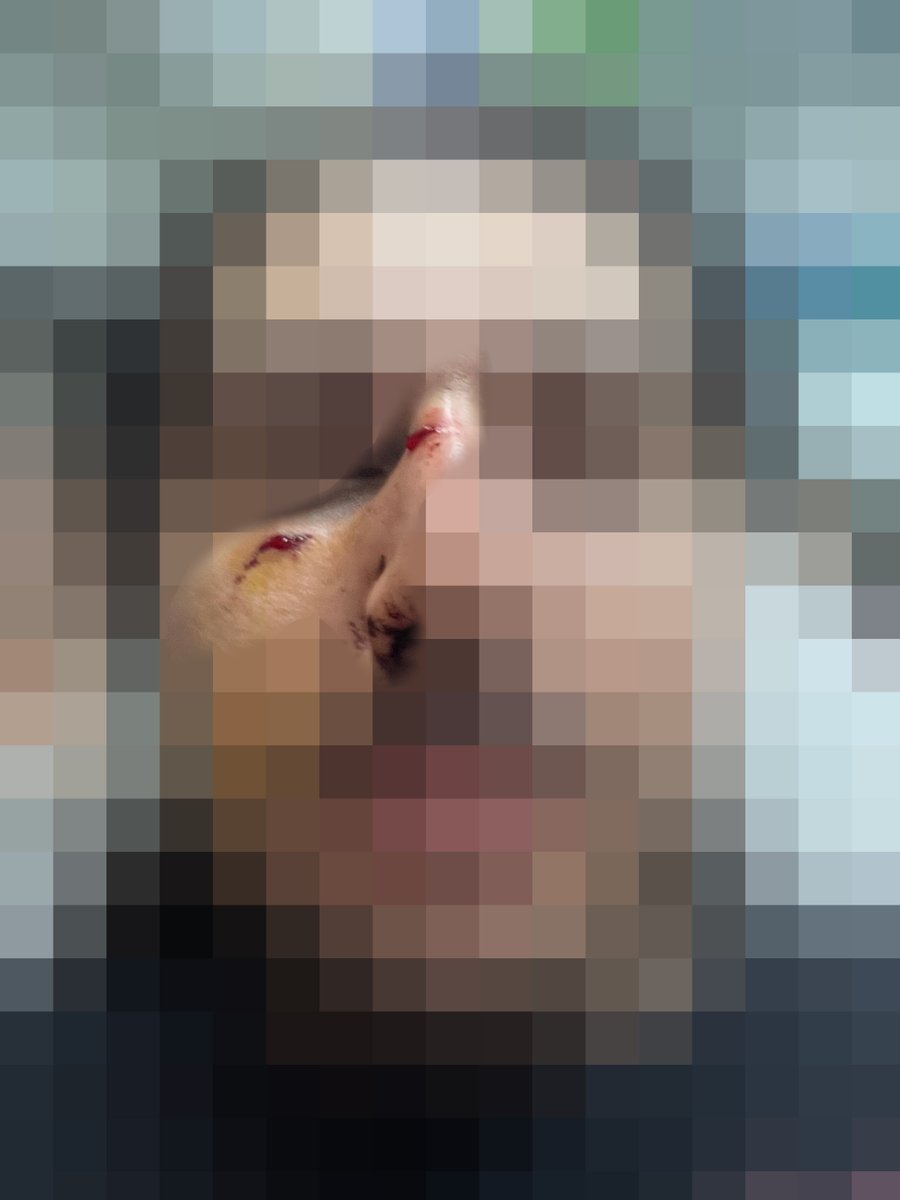 JagermaNz's tweet photo. 2 gün önce 9 suç kaydı bulunan tacizci bir şahıs tarafından bıçaklı saldırıya uğradım ve suratımdan yaralandım, birkaç kesik ve burnumda çatlak dışında ciddi bir şeyim yok.
Karşılık vermem sonucu şahıs bıçağını düşürüp kaçsa da polisler gelince yakalandı ve şikayetim sonucunda tutuklandı, mahkeme süreci olacak ve ileride tahliye edilme ihtimali var.
9 suç kaydı olan biri neden ve nasıl rahat rahat dışarda gezebiliyor, tutuklu kalması için birine ciddi bir şey mi olması gerekiyor?
En önemlisi de serbest kalıp peşime düştüğünde kendimi savunup ben mi ceza alacağım?