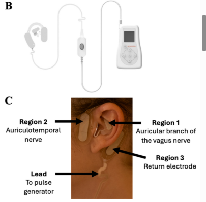 BioelectronicM's tweet photo. Effects of transcutaneous auricular vagus nerve stimulation or combined vagal and trigeminal nerve stimulation on platelet function and laboratory hemostasis parameters in healthy human subjects | #BioelectronicMedicine #TaVNS #TrigeminalNerve #platelets https://t.co/6sOD1ylzJ3 https://t.co/GGpT2aPKhs