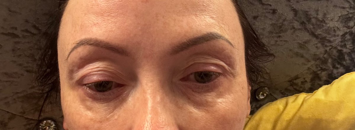 NickyH2110's tweet photo. @BootsUK I bought this product from you as it was advertised as being suitable for sensitive eyes. It’s caused an allergic reaction. Confirmed by a pharmacist. I have never reacted like this to a mascara. I am in a lot of pain with burning, itching, swollen watery eyes. https://t.co/ndqeVun5C5