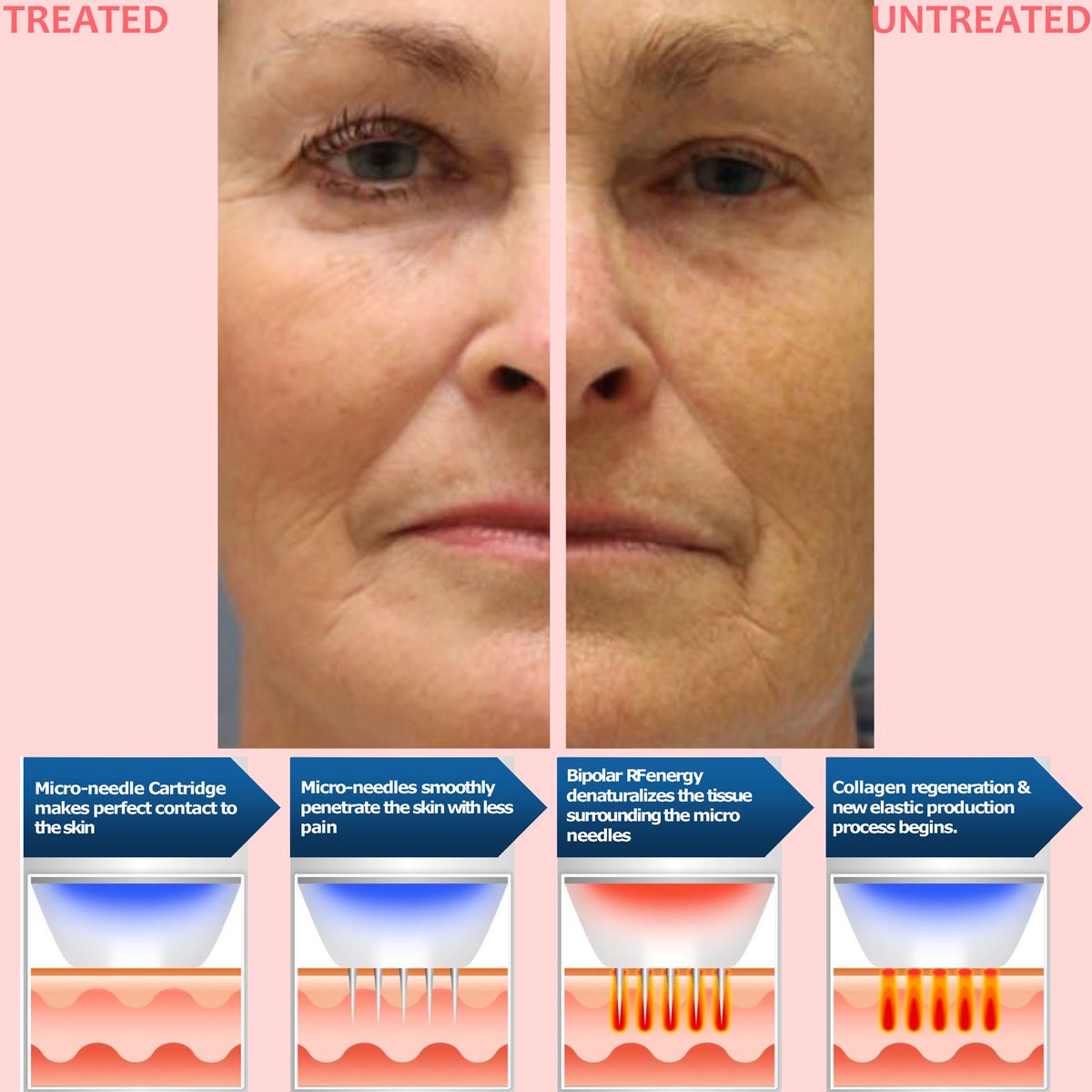 Amoderm's tweet photo. RF-Needling Special - https://t.co/4aWPiMCjoI https://t.co/Esrlng7DHs