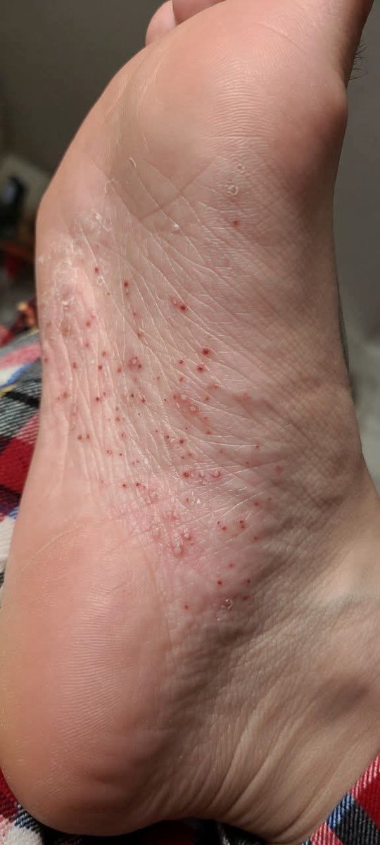 albertoortegana's tweet photo. Spot Diagnosis ❓

A 46-year-old woman presents with a 6-month history of recurrent painful eruptions involving both palms and soles.
On examination:

- Symmetrical involvement of the palms and soles.
- No obvious signs of bacterial infection.

❓What's your diagnosis https://t.co/0Zd56z7aFT