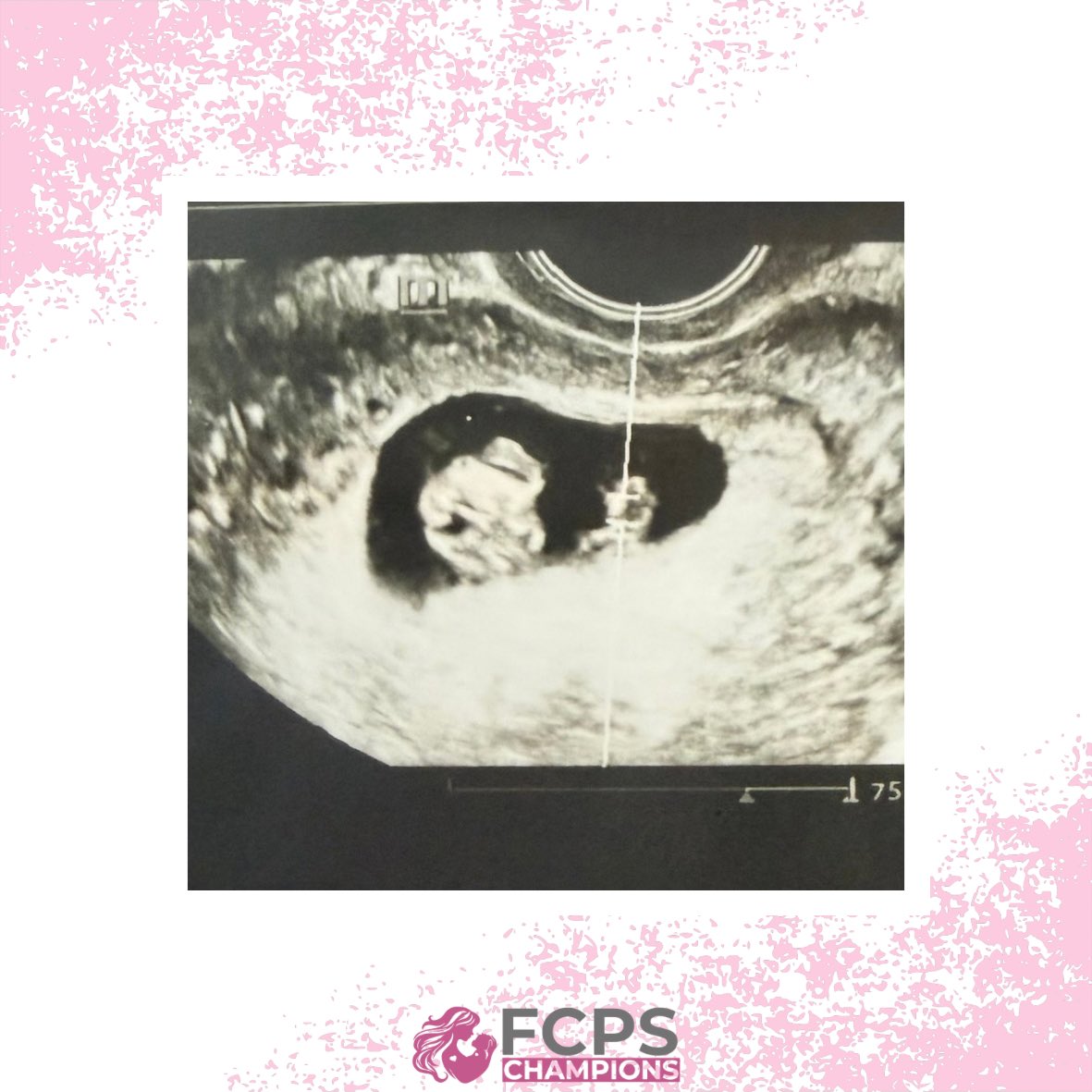 fcps_champions's tweet photo. She came to our center facing an unexpected pregnancy and an uncertain future, and she received the news of a double blessing. ♥️♥️ https://t.co/fth56vY5no