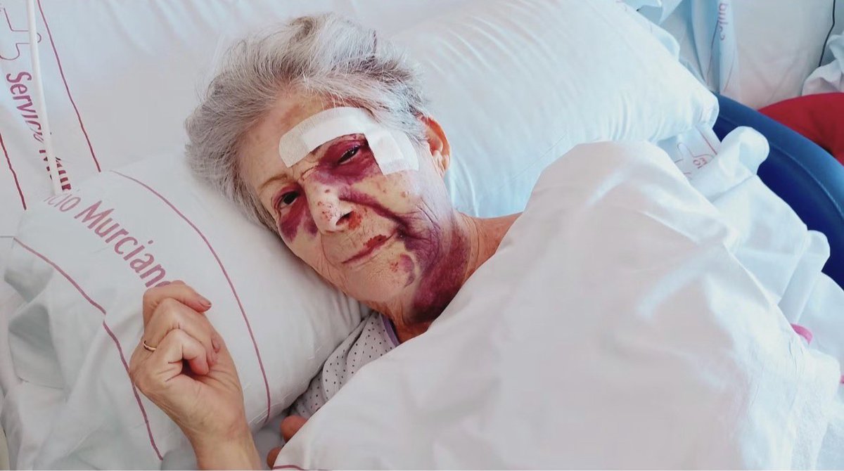 javiernegre10's tweet photo. Esta señora se llama Ginesa.

Un miserable de unos 20 años, 1,80 de estatura y origen magrebí —según fuentes del caso— le ha destrozado literalmente la cara a golpes para robarle el bolso en Santiago de la Ribera, Murcia.

Brutalidad pura. Sin piedad. Así están las cosas en la calle.

¿Hasta cuándo vamos a seguir tolerando que toquen a nuestros mayores?