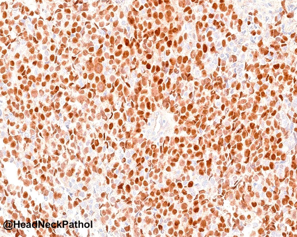 HeadandNeckPath's tweet photo. Genomic &amp; Epigenetic Comparative Study of Low-grade Biphenotypic Sinonasal Sarcoma w/ Metachronous &amp;Synchronous High-grade Rhabdomyosarcomatous Transformation
Sibira, Chen, et al
https://t.co/9Je2MjIoJm
#HeadNeckPathol #HNPJ #HeadandNeckPath #Pathology #ENTPath #PathologyTweet https://t.co/rAoML9Aizj