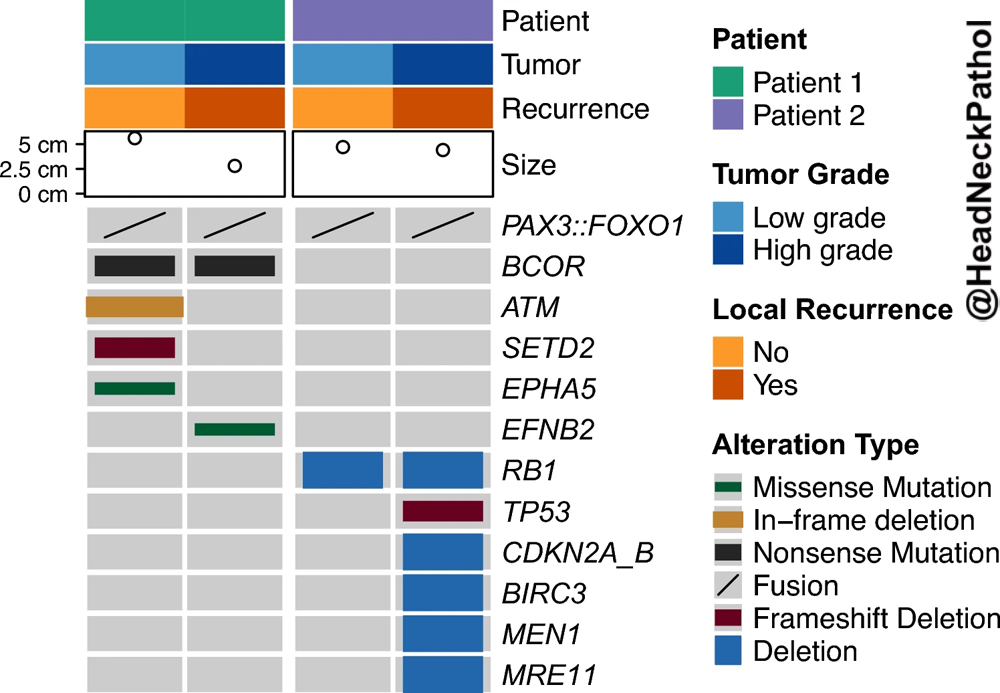 HeadandNeckPath's tweet photo. Genomic &amp; Epigenetic Comparative Study of Low-grade Biphenotypic Sinonasal Sarcoma w/ Metachronous &amp;Synchronous High-grade Rhabdomyosarcomatous Transformation
Sibira, Chen, et al
https://t.co/9Je2MjIoJm
#HeadNeckPathol #HNPJ #HeadandNeckPath #Pathology #ENTPath #PathologyTweet https://t.co/rAoML9Aizj