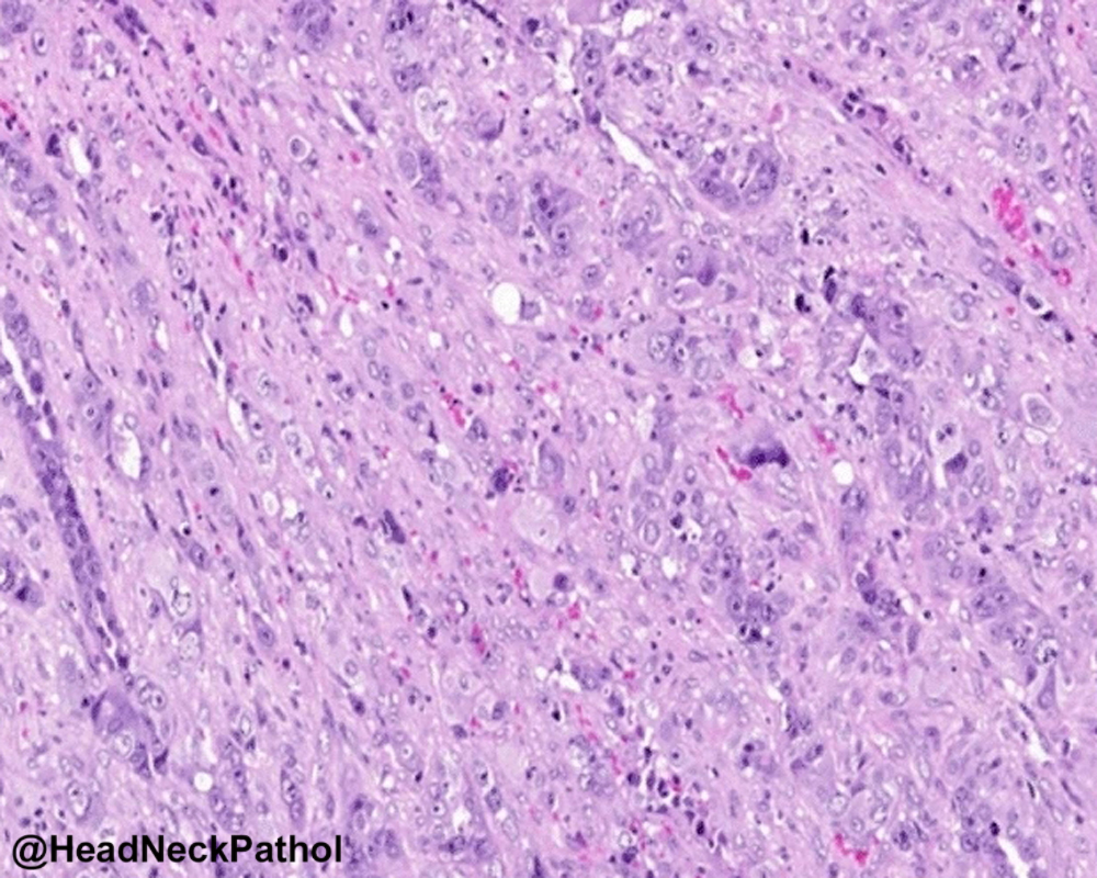 HeadandNeckPath's tweet photo. Metastatic Cancers to the Oral Cavity: A 42-Year Experience
Pornpop Rattana-arpha, Kittipong Dhanuthai &amp; Ekarat Phattarataratip
https://t.co/0OMOEULzGi
#HeadNeckPathol #HNPJ #HeadandNeckPath #Pathology #ENTPath #PathologyTweet https://t.co/6S7UqlWNjQ