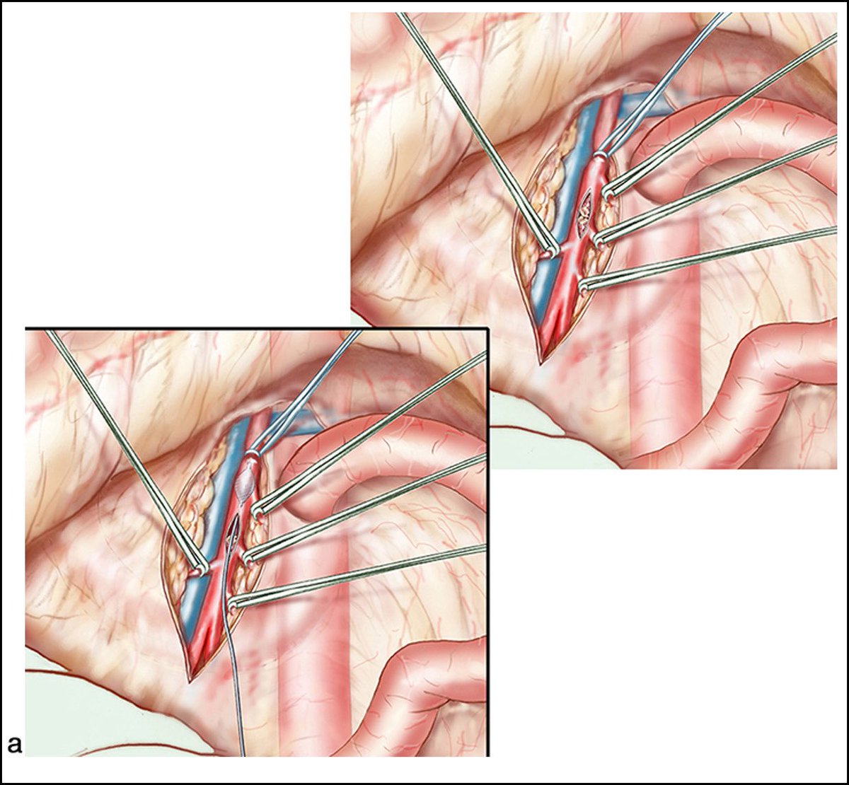 PipeCabreraV's tweet photo. Arterial revascularization following acute mesenteric ischemia: Superior mesenteric artery open embolectomy! @TomVargheseJr @AmCollSurgeons @SWexner @pferrada1 @CiruAndes2 @BJSAcademy https://t.co/RwOSd6M16W