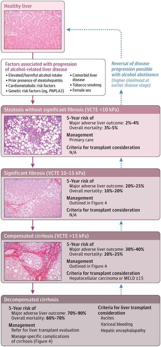 drkeithsiau's tweet photo. Alcohol related liver disease - new JAMA review July 2026 🚨

1️⃣ Pathophysiology ⚙️
2️⃣ Progression ➡️
3️⃣ Assessment 💡
4️⃣ Management 💊

📸: https://t.co/yfAzCbrx3P https://t.co/BvXels8NZm