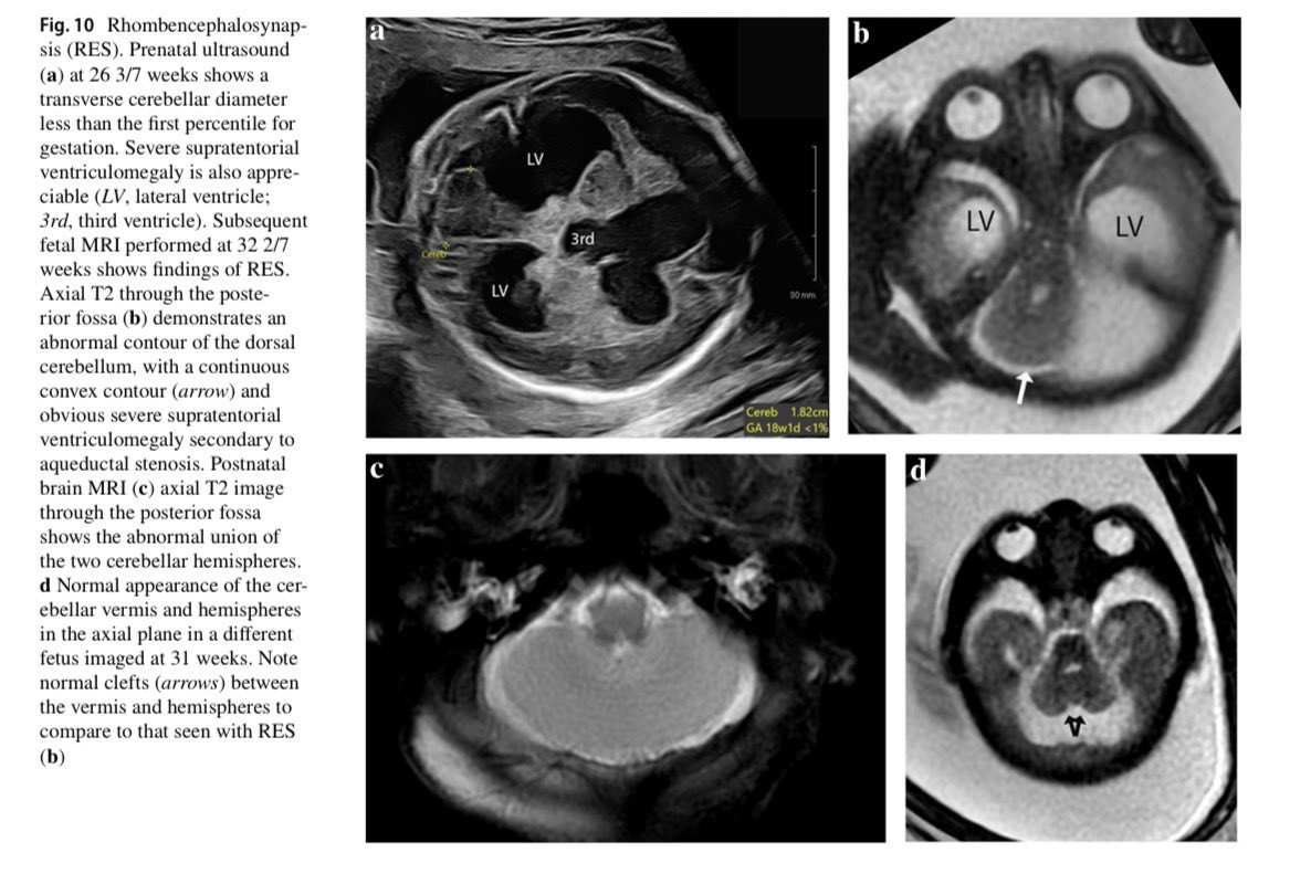 JorgeMincholaVe's tweet photo. La rombencefalosinapsis es una anomalía crítica de la organización prenatal que suele pasar desapercibida. 
💡 Hallazgos clave: Fusión de hemisferios cerebelosos, agenesia del vermis y 4to ventrículo en "diamante". 

RM fetal en 3er trimestre es el estándar para su confirmación. https://t.co/JBLXiibFjn