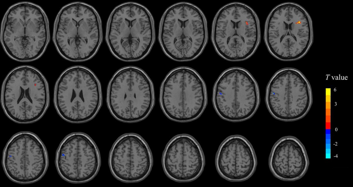 Richie_OFarrell's tweet photo. To give you an idea of the quality of this study: it includes the following figure – the colours reflect differences in brain activity between those who said they watched lots of short videos vs those who said they didn’t. It took me about a minute to spot any colour at all. https://t.co/vNncrfG9hD