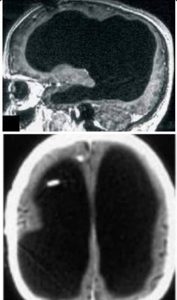 BrianRoemmele's tweet photo. 90% Of His Brain Was Missing And No One Knew It.

—

In 2007 in France, a 44-year-old man went to the doctor complaining of numbness in his leg and underwent a brain CT scan that revealed a shocking truth.

That man didn't have 90% of his brain. The skull was almost entirely filled with cerebrospinal fluid and all that remained of the brain was a thin peripheral portion surrounding the skull.

Yet that man, whose IQ was just below average (IQ 75), had been leading a normal life for years: he was married, had two children, a job and was obviously aware of himself, he moved, laughed, loved and ultimately he lived.

The case shocked the world scientific community and was described in the prestigious Lancet journal, becoming the subject of questions and amazement.

The evidence of the facts raised, as can easily be imagined, many questions about the very concept of consciousness, understood as "awareness of the self" and the possibility of leading a normal life practically without a brain.
The patient's clinical history was reconstructed and it was discovered that he was born suffering from a form of hydrocephalus. 

For this reason, a few months before his life, a cerebral shunt was inserted into his skull, capable of draining excess cerebrospinal fluid. That shunt was removed at the age of 14 and the patient, after an initial series of problems that had caused paresis in his left leg, was eventually able to resume an almost normal life and had completely forgotten about the problem.

Over the next 30 years, the liquor began to invade the skull again and progressively erode the brain (90% of the brain!), leading to that feeling of weakness in the leg which prompted the patient to undergo a medical examination. at the age of 44. 

But all this was not able to explain how the brain invaded by cerebrospinal fluid and eroded by 90% of its volume had "known" to recalibrate itself over the years, allowing him to lead a normal life anyway.

Axel Cleeremans, a cognitive psychologist at the Université Libre of Brussels, Belgium, attempted to answer these questions in 2016 during a conference of the Association for Scientific Studies on Consciousness, held in Buenos Aires.

According to Cleeremans, the case of the French patient had demonstrated the extraordinary "readaptation capacity" of the human brain. The frontal, parietal, temporal and occipital lobes of the brain, in fact, preside over the main cognitive and perceptive functions, yet in the patient they were practically completely absent and this demonstrated that the brain of that man - and therefore of every man - had been able to "move" those functions to the residual perimeter section of 10%.

The second ability that was made evident by the clinical case under examination was the "plasticity of the brain". According to Cleeremans' hypothesis, "self-awareness" (or detailed self-cognition) is formed through experience, the relationship between oneself and the surrounding world and learning, and is subject to continuous modifications and adjustments in course of life.

The case of the French man who lived a normal life until the age of 44 without 90% of his brain demonstrated to science a fact that had until then been unknown, namely that just 10% of the brain tissue is sufficient to re-elaborate a “theory of the self” and to make that person a man in all respects.

We can’t even begin to know what we don’t know…

For the Reddit “actually” debunker types. Read this before you move your thumbs: https://t.co/m2qsol172F