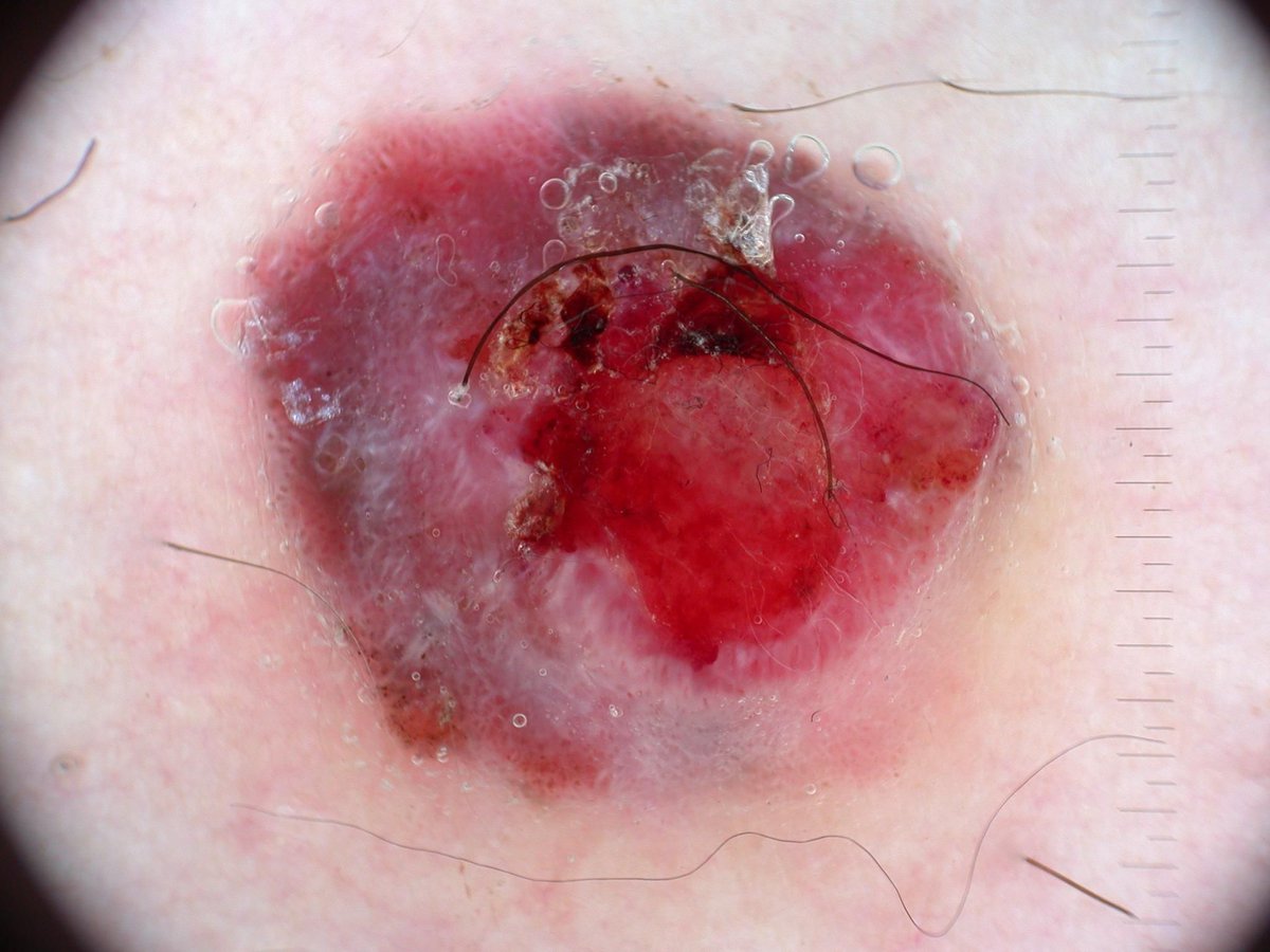 dermatology's tweet photo. A patient presents with this dermoscopic finding.

🧩 Dermatology Case — What's your dx? ______

Answer = https://t.co/JPIBmptjum https://t.co/Ry2cbspNR5