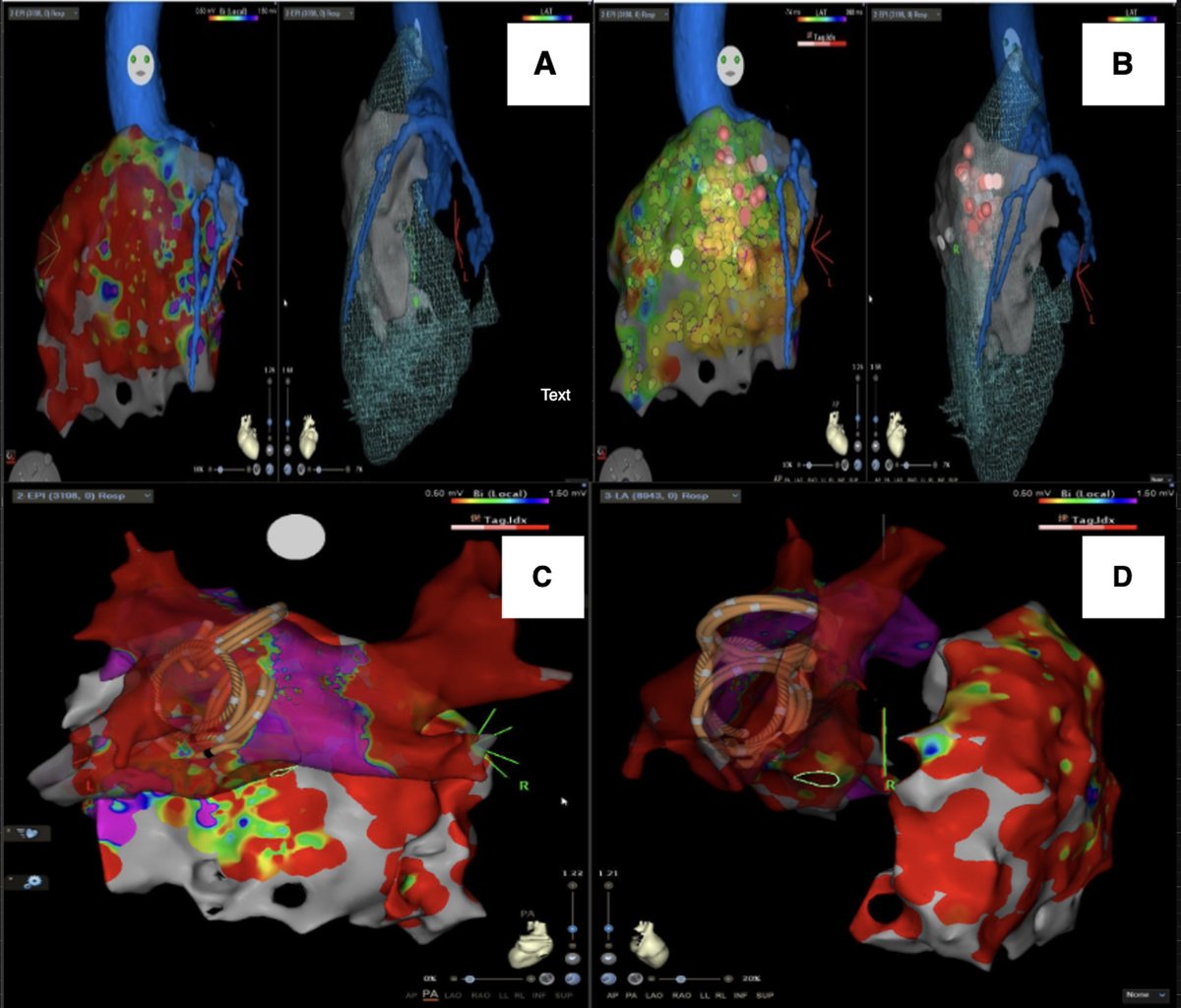 HRS_CaseReports's tweet photo. Combined Epicardial Substrate Ablation and Pulsed Field Pulmonary Vein Isolation in Brugada Syndrome
https://t.co/qmcDViLydt https://t.co/3bsLAZJGfg