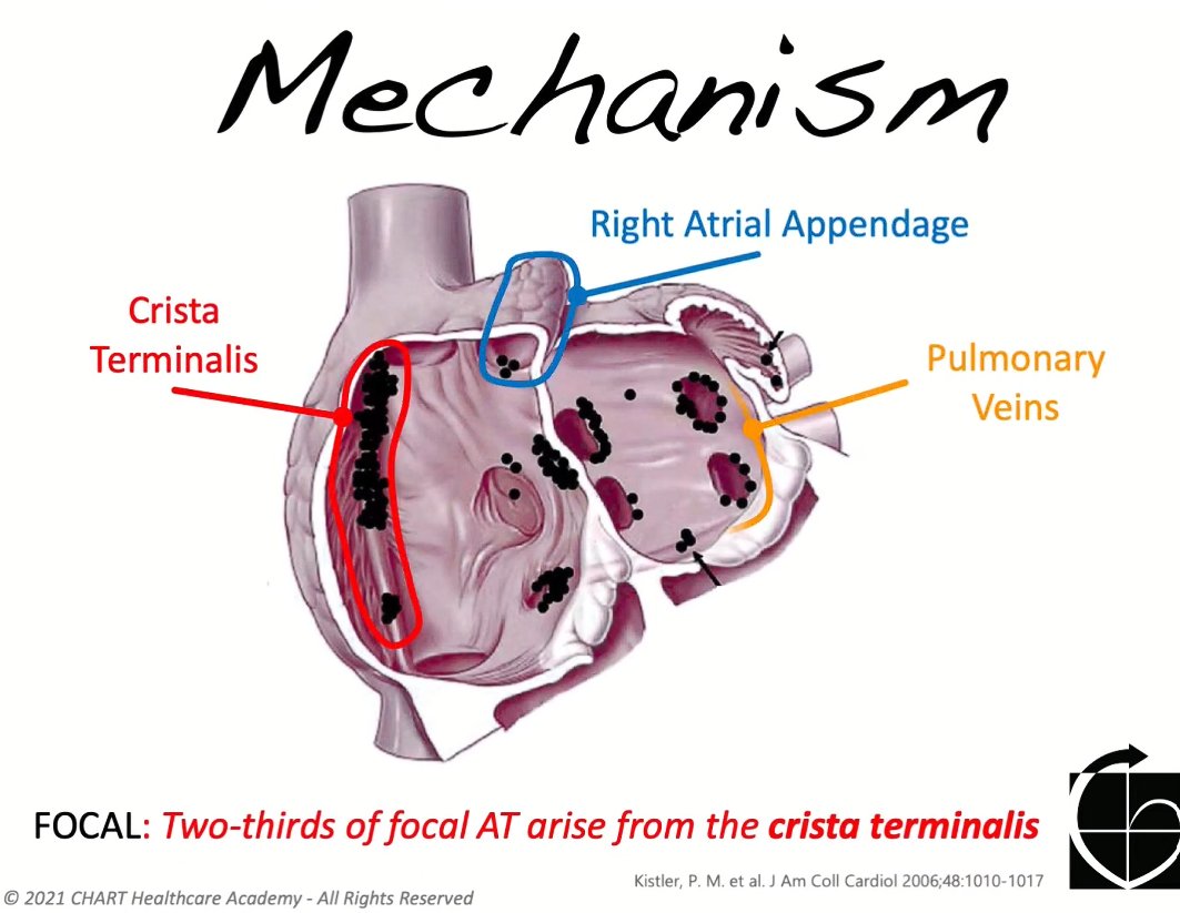 ChartAcademy's tweet photo. 🫀 EP Burst: Atrial Tachycardia⏱️

What is atrial tachycardia? How do you recognize it? Why does it matter?
🔗Link in bio!

#EPBurst #AtrialTachycardia #Electrophysiology #EPeeps #RCES #CardiacEP

https://t.co/xb33f9HpMF https://t.co/AKG1XxvAfA
