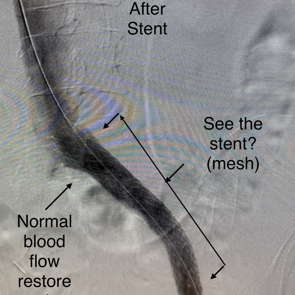 AprilWW911LC's tweet photo. Edogawa-McMairn clinical trial departure 7/17. 
I completed the L iliac vein stent surgery 6/30. Recovery has been truly difficult. My hope is to open my venous system to allow the Japan trial to be more effective. Below are some graphics regarding May Thurner Syndrome. Spike attacked our vascular system (and in my opinion our connective tissue). Dr McDermott found 75% compression of my L iliac vein, 42% compression of my L renal vein and also compression of the blood supply to my stomach. All of which is new since spike found its way into my body. 
I truly appreciate all the kind words of support. This battle feels less lonely and I wouldn’t wish it upon anyone. If you find yourself wanting to help or repost please considering sharing my GFM. 100% of funds are going to Edogawa hospital for my treatment. No fluff, no travel just treatment. 
Venmo: @april-amber-theisen

https://t.co/512rRJDe1V