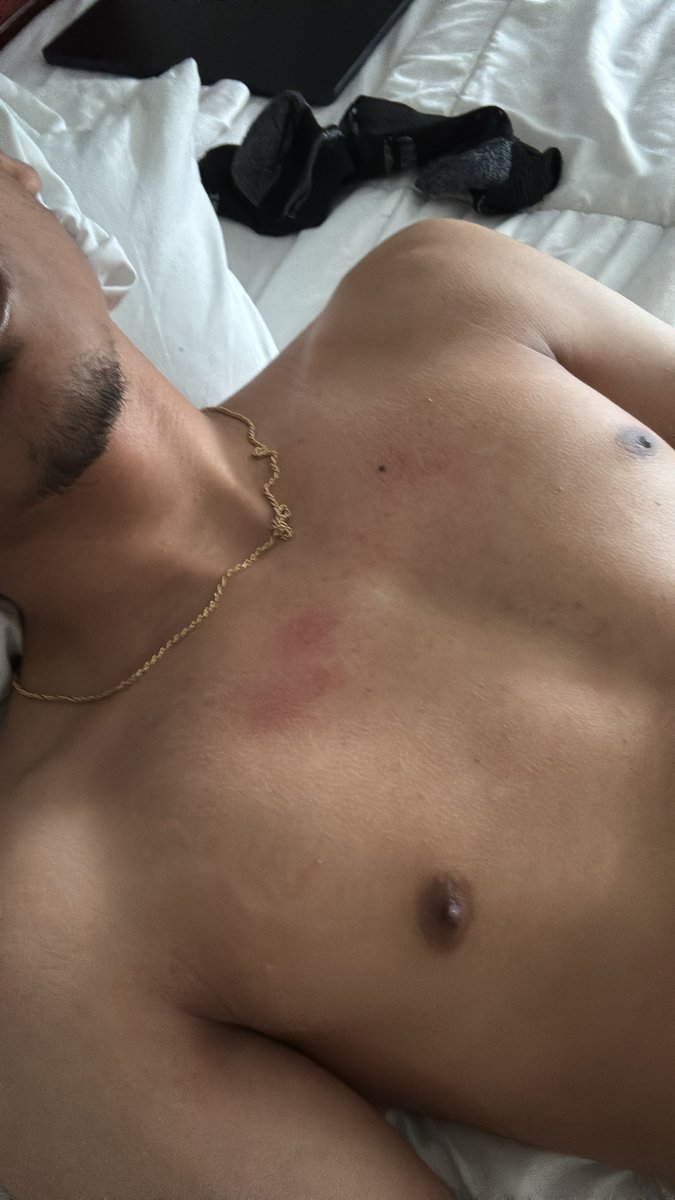 FhgjjJackb50261's tweet photo. Bruised my chest at the gym 💔 https://t.co/VGhuNBYjzC