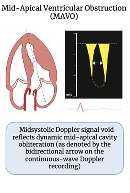 iamritu's tweet photo. Have you seen the “void”?

in midapical HCM with midventricular cavity obliteration, CW Doppler shows midsystolic interruption of forward flow -the “void”

MAVO HCM ⬆️ prevalence of apical aneurysm, can miss Dx if use peak gradient only #echofirst 
🔗 https://t.co/wtNKtom3r3 https://t.co/3lXbHWr4e7