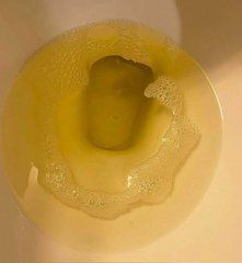 VargasKevi70887's tweet photo. Señales que indican que tienes resistencia a la insulina (y no te das cuenta)  

1. Aparición de espuma al orinar https://t.co/oUFTevaLLM