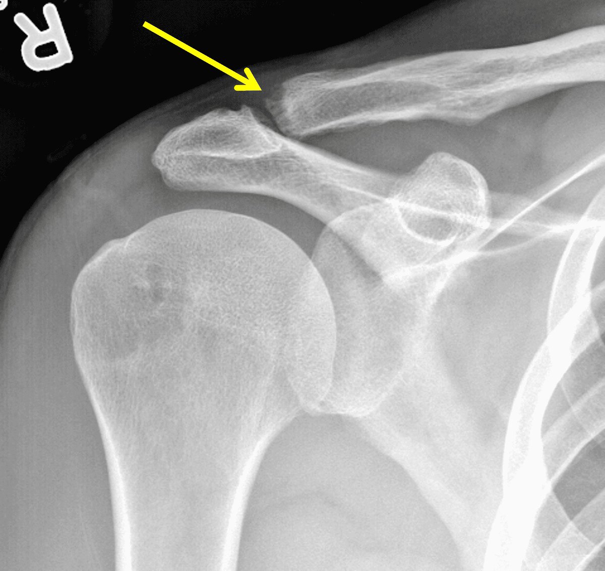 MedEd_Cases's tweet photo. The resisted AC joint extension test evaluates for AC joint pathology. 

The patient is seated with the examiner positioned behind them. The shoulder is flexed to 90°, internally rotated, and the elbow flexed to 90°, after which the examiner applies resistance at the lateral elbow while the patient attempts to abduct the arm. 

A positive test reproduces pain localized over the AC joint, suggesting AC joint. 

Sensitivity 72%, specificity 85%. 

Read: https://t.co/uxaJQzeitG

Watch: https://t.co/afVyZMgEVC

#ShoulderPain #SportsMedicine #PhysicalTherapy #Orthopedics #MedicalEducation