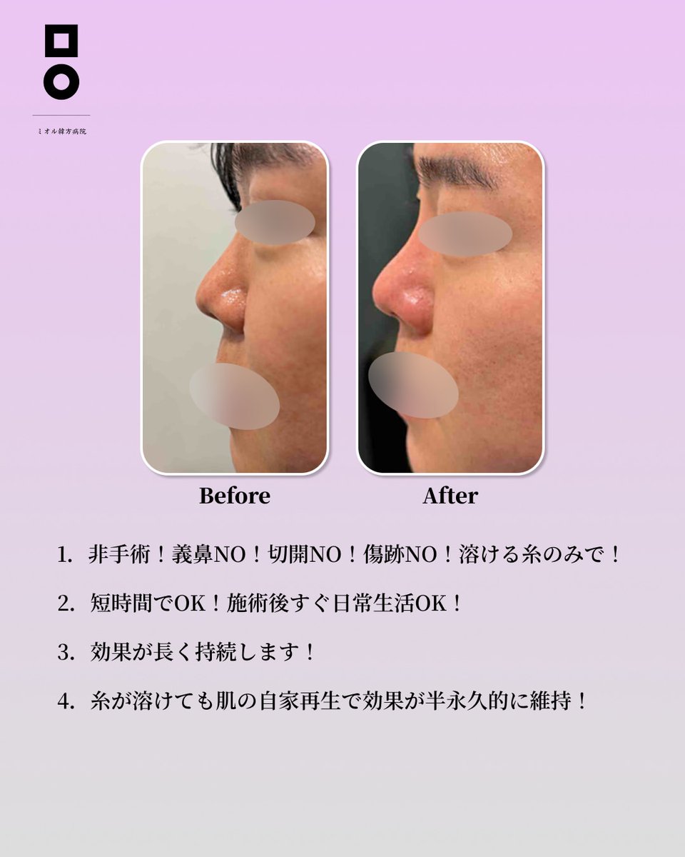 mialljp's tweet photo. 非手術で高くなる鼻✨

＜鼻埋線＞
鼻糸リフト2本➡35万ウォン
鼻糸リフト6本➡55万ウォン
鼻糸リフト10本➡75万ウォン

#韓国施術　#韓国クリニック　#韓国情報　#韓国美容　#美容クリニック　#美容情報　#鼻埋線　#鼻整形 https://t.co/w7Lvpvxxoz
