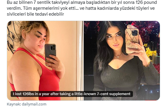 drahmetrasim's tweet photo. Aida Azizii adlı 25 yaşındaki bir kadının hikâyesi:
"Bu az bilinen 7 sentlik takviyeyi almaya başladıktan bir yıl sonra 57 kilo verdim. Tüm aşermelerimi yok etti... ve hatta kadınlarda yüzdeki tüyleri ve sivilceleri bile tedavi edebilir."
Polikistik over sendromu (PCOS) hastası olan Aida, myo-inositol adlı ucuz bir takviye kullanmaya başladıktan sonra 1 yılda yaklaşık 57 kg zayıflamış. Şekerli yiyeceklere olan aşırı iştahı kısa sürede kesilmiş. PCOS’ a bağlı yüz kıllanması ve akne sorunları da iyileşmiş.
Myo-inositol, B8 vitamini olarak da bilinen, vücutta tabii olarak bulunan bir şeker alkolüdür. Meyve, sebze, baklagiller, fındık ve tahıllarda tabii olarak bulunur.
En çok ne işe yarar?
İnsülin duyarlılığını artırır → İnsülin direncini azaltır.
Hormon dengesini destekler → Özellikle PCOS tedavisinde çok popüler.
Özellikle PCOS’ u olan, insülin direnci olan veya hormonal dengesizlik yaşayan kadınlarda tamamlayıcı olarak en çok araştırılan ve umut vadeden takviyelerden biri ama mucize değil.
NOT: Takviye tavsiyesi değildir, bilgilendirme maksatlıdır.