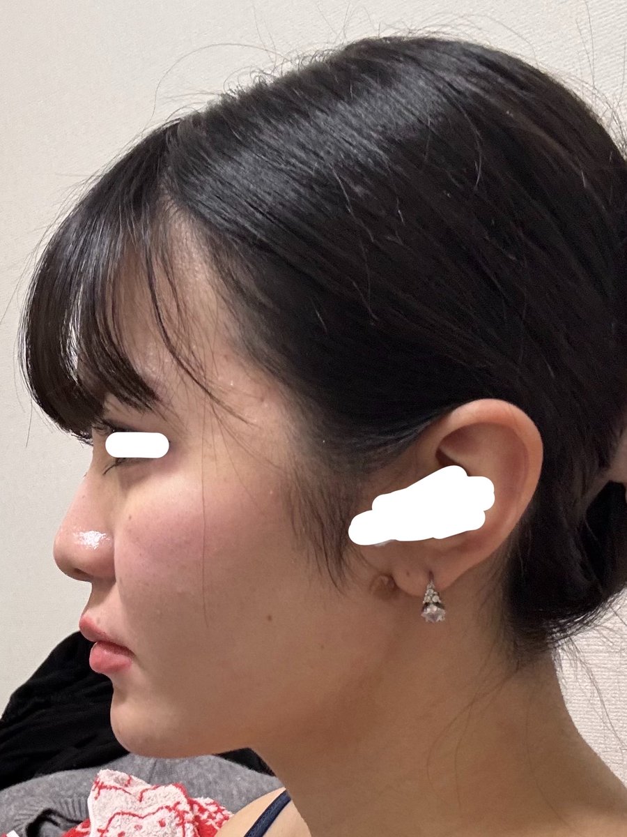 Q_Qsand's tweet photo. 鼻ってまじで大事だと思った
 #整形垢 https://t.co/qjEHOxdYmt