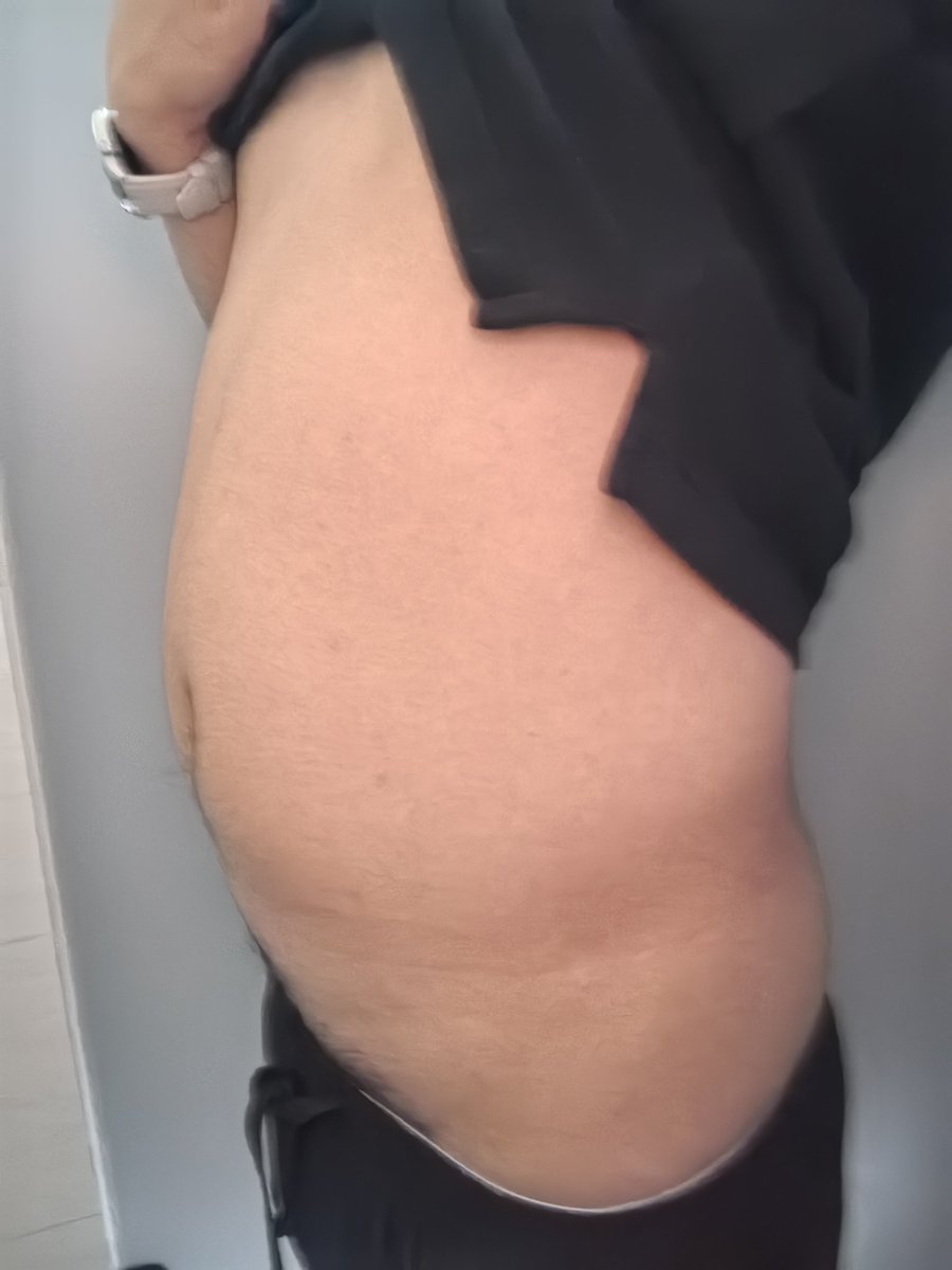 eToRgLl68K92637's tweet photo. 变化挺大，不是吗 #bellyinflation #bigbelly https://t.co/jjt8XjhHMt