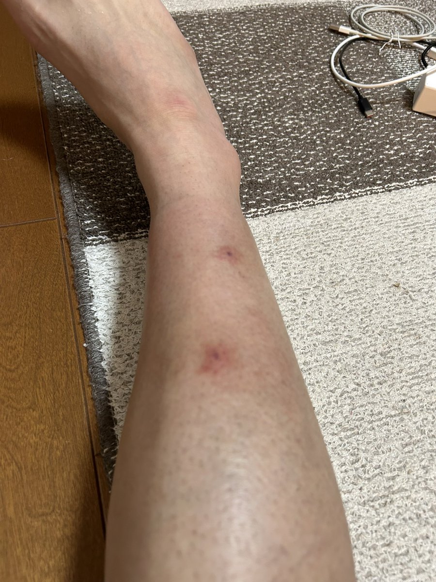 tomato3672's tweet photo. 土曜日のBBQで虫に食われた所、ムヒ塗り続けてるのにまだパンパンなの嫌すぎる
田舎の虫強いw https://t.co/wGoNgTnN9W