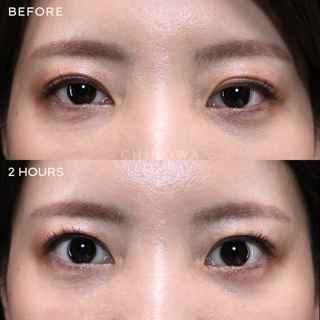 dr_risa_y's tweet photo. 【アップニークとSBCアイブースターの違い】

どちらも“目が開く系の目薬”として見られがちですが、成分の立ち位置は少し違います。

アップニーク（オキシメタゾリン塩酸塩0.1%）は、
眼瞼下垂に対して、ミュラー筋を収縮させて上まぶたを挙上させる作用がメインです。

一方で、SBCアイブースター（ナファゾリン硝酸塩）は、
本来は白目の充血改善がメインの成分で、
まぶたを上げる作用は、副次的・美容的な使い方です。

持続時間も、
アップニークは8時間程度、
SBCアイブースターは2〜3時間程度。

つまり
アップニークは「まぶたを上げる薬」寄り。
SBCアイブースターは「充血を取って、目をすっきり見せる薬」寄り。

同じ“目が開く系”に見えても、中身はけっこう違います。

（症例写真はアップニークを使用しています。）