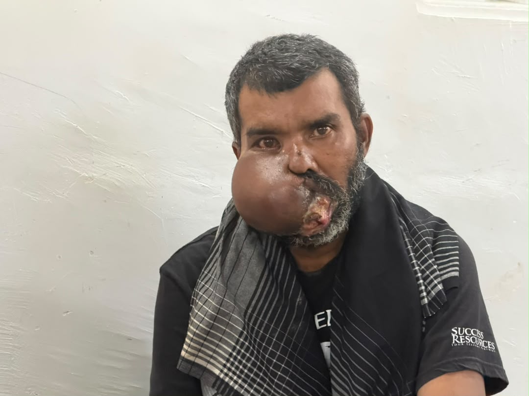 SinarOnline's tweet photo. 'Saya mahu sembuh' - Penggali kubur derita kanser mulut rayu bantuan

"Saya dah tak boleh buka mulut untuk makan. Setiap hari saya hanya minum guna tiub kerana itu sahaja cara untuk saya dapatkan tenaga."

BACA: https://t.co/i1XVqoA6yI

#sinarharian #beritaterkini #kanser https://t.co/41cvNqgMYx
