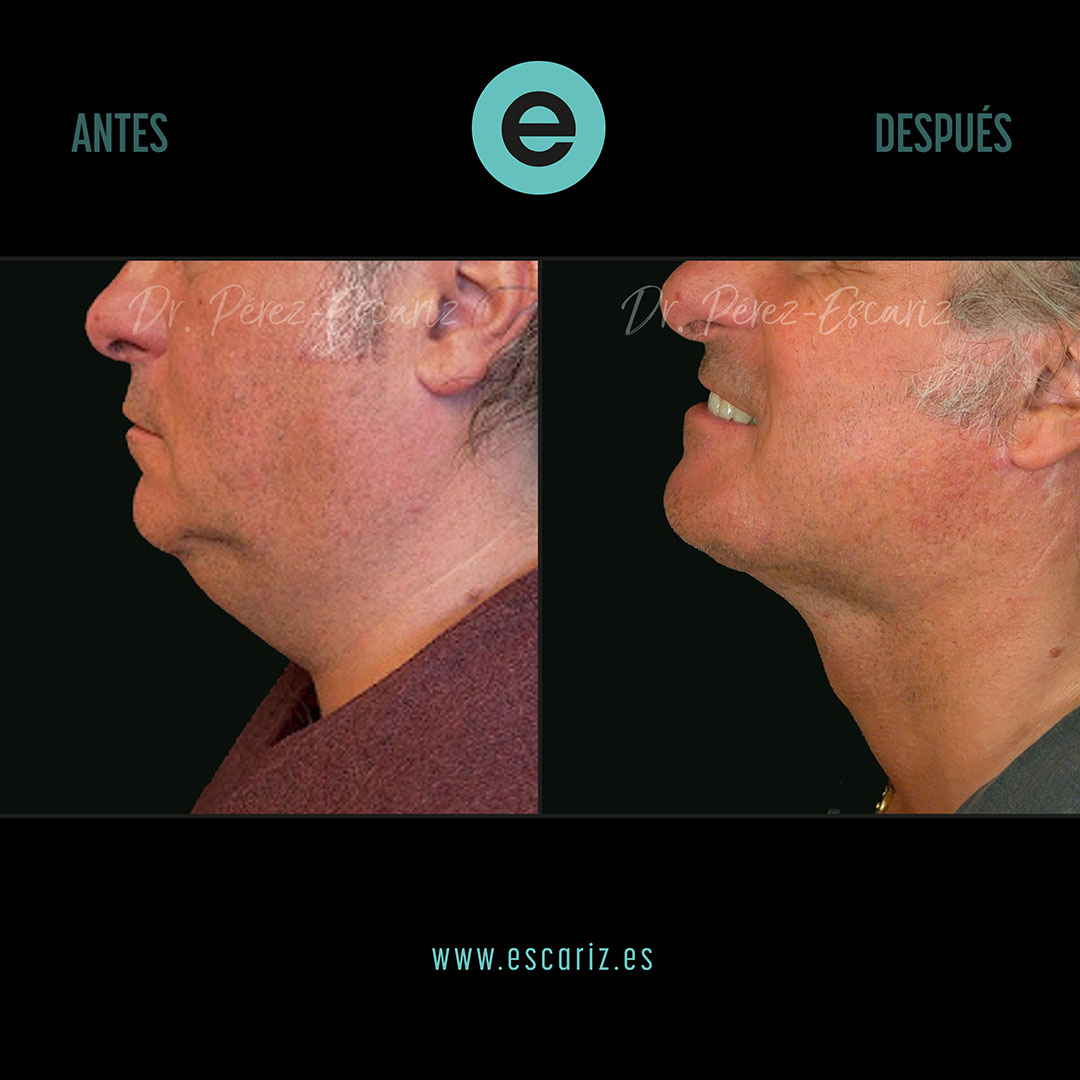 DrPerezEscariz's tweet photo. 🧠✨ El rejuvenecimiento del cuello va más allá de la piel.
En este caso realizamos un lifting cervical Dual-Plane, actuando sobre planos profundos para redefinir el cuello y la línea mandibular.
Resultado natural, estructural y duradero.
#LiftingCervical #DualPlane https://t.co/NtG42mJ4iw