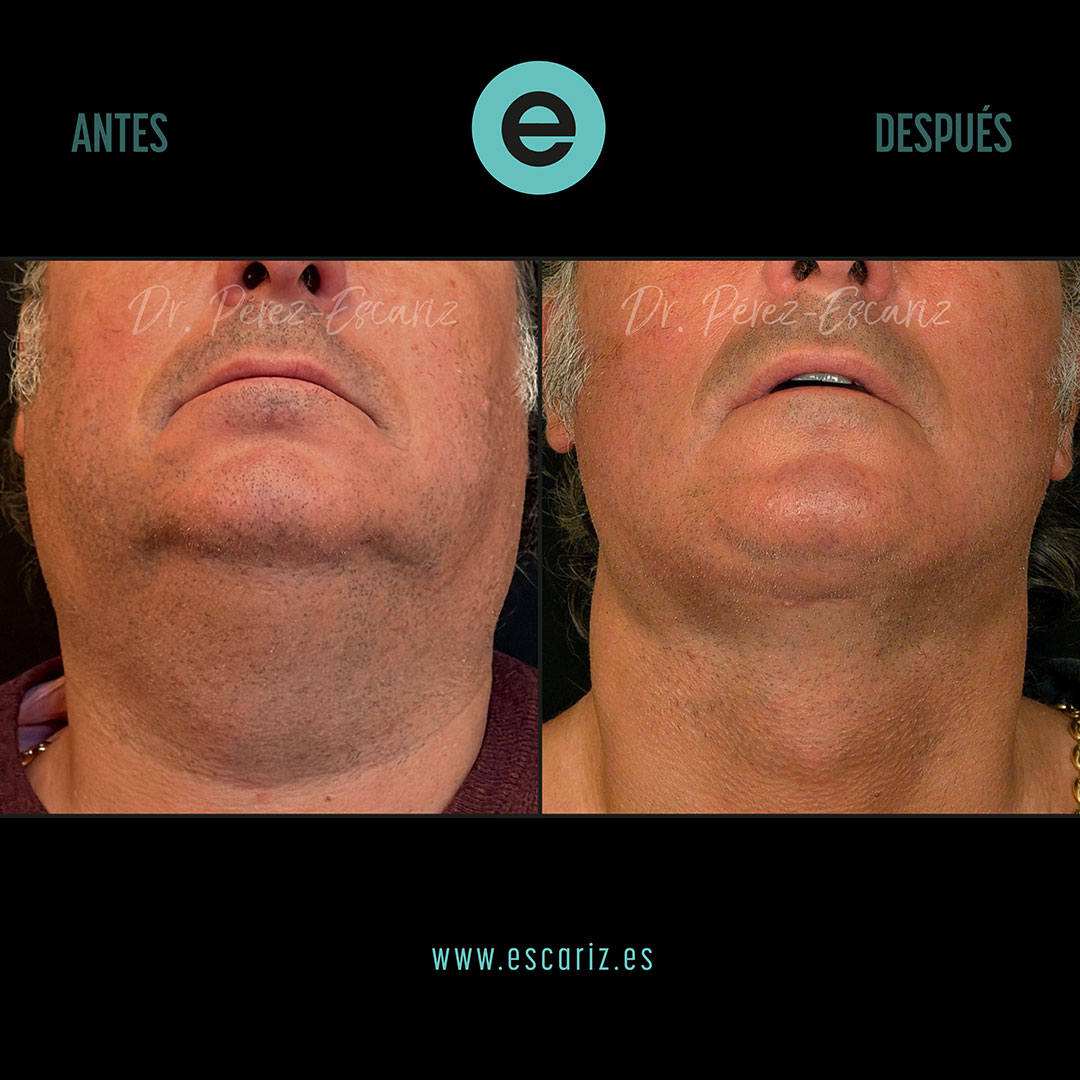 DrPerezEscariz's tweet photo. 🧠✨ El rejuvenecimiento del cuello va más allá de la piel.
En este caso realizamos un lifting cervical Dual-Plane, actuando sobre planos profundos para redefinir el cuello y la línea mandibular.
Resultado natural, estructural y duradero.
#LiftingCervical #DualPlane https://t.co/NtG42mJ4iw