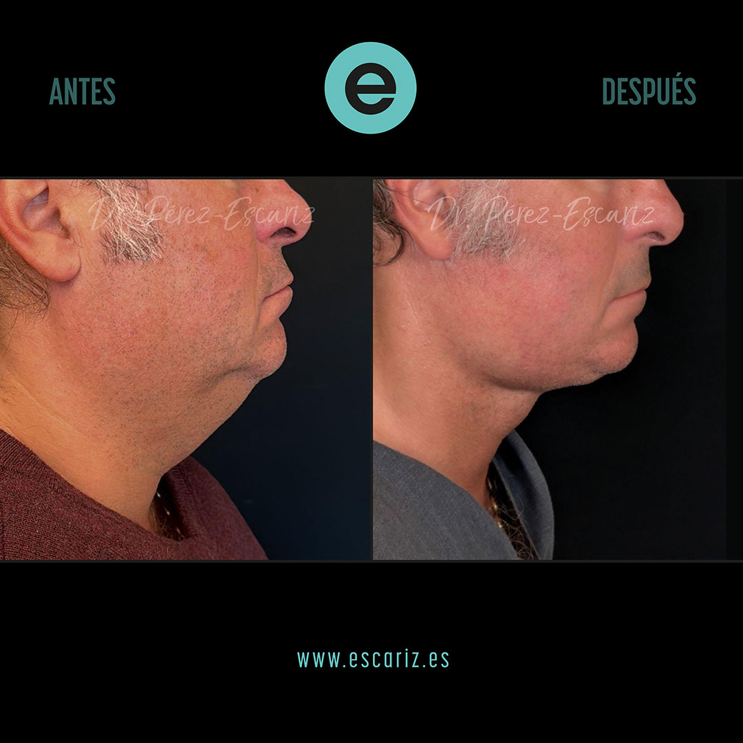 DrPerezEscariz's tweet photo. 🧠✨ El rejuvenecimiento del cuello va más allá de la piel.
En este caso realizamos un lifting cervical Dual-Plane, actuando sobre planos profundos para redefinir el cuello y la línea mandibular.
Resultado natural, estructural y duradero.
#LiftingCervical #DualPlane https://t.co/NtG42mJ4iw