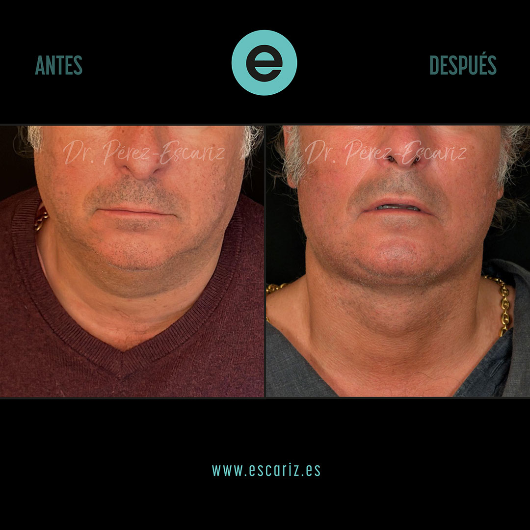 DrPerezEscariz's tweet photo. 🧠✨ El rejuvenecimiento del cuello va más allá de la piel.
En este caso realizamos un lifting cervical Dual-Plane, actuando sobre planos profundos para redefinir el cuello y la línea mandibular.
Resultado natural, estructural y duradero.
#LiftingCervical #DualPlane https://t.co/NtG42mJ4iw