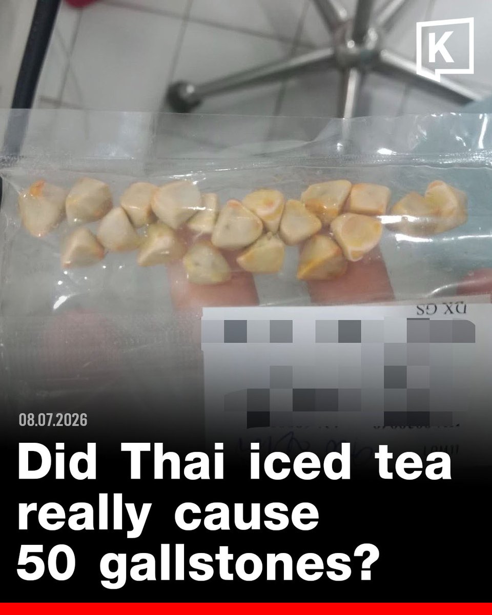 KhaosodEnglish's tweet photo. A woman’s viral post blaming a 10-year daily Thai iced tea habit for nearly 50 gallstones has sparked dicussion and fears online.

But can Thai iced tea really cause gallstones? 🧋

Medical evidence suggests the link is not so simple. Tea contains oxalate, which is more relevant to kidney stones, while gallstones are usually linked to bile, cholesterol, diet, weight and metabolic risk.

So the real concern may not be the tea itself — but years of sugary drinks as a daily habit.
