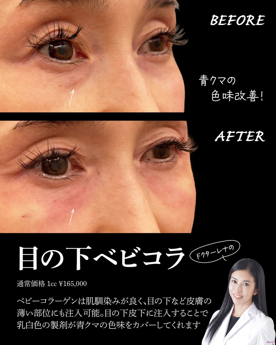 Rejuva3's tweet photo. 目の下の青クマ治療に人気の
≪ベビーコラーゲン≫

目の下の皮膚は薄いため
ヒアルロン酸などを浅い層に注入してしまうと、透けて見えるリスクがあります
ベビーコラーゲンは肌馴染みが良いため、目の下の治療に適した製剤です

ご予約はこちらから
LINE@rejuva
https://t.co/CAmIyUYJYe
#青クマ https://t.co/onkWHiVxkE
