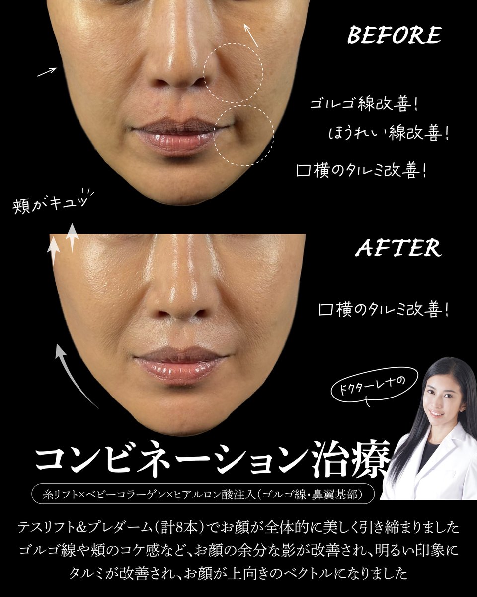 Rejuva3's tweet photo. ドクターレナのタルミをケアする
≪コンビネーション治療≫

・糸リフト
・ベビコラ（目の下）
・ヒアルロン酸（鼻翼基部＆ゴルゴ）

糸で引き締め、ヒアルで補い、ベビコラで整える
コンビネーションによる美しい仕上がりです😆

ご予約はこちらから
LINE@rejuva
https://t.co/CAmIyUYJYe https://t.co/gSP7cYBfP2