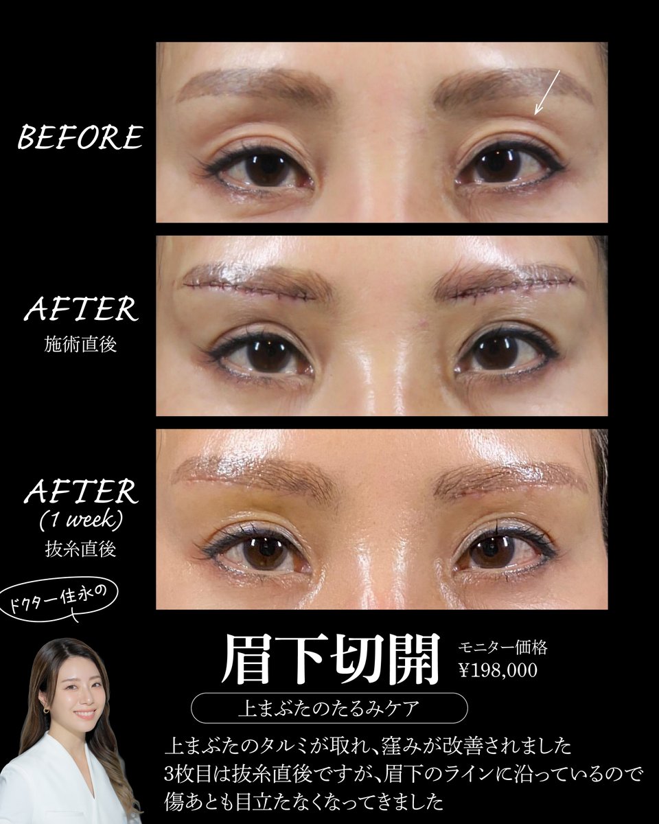 Rejuva3's tweet photo. 形成外科専門医
住永先生による
≪眉下切開≫
ビフォーアフター

目の上のタルミは
なかなか治療が難しい部位のひとつです
眉下切開は、上瞼の余剰皮膚を切除することで、タルミを改善する手術です

ご予約はこちらから
LINE@rejuva
https://t.co/CAmIyUYJYe https://t.co/m6MngXwh7P