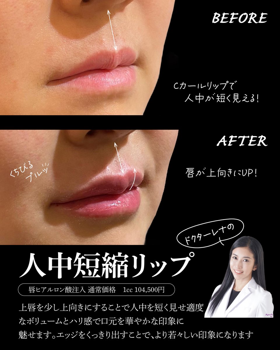 Rejuva3's tweet photo. 人中短縮リップ💋

人中は短く見せたい
けど手術はしたくない
そんな方にオススメ✨

ドクターレナの人中短縮リップ
ヒアルロン酸でナチュラルに人中を短く見せます
（人中短縮ボトックスとの併用もオススメ）

ご予約はこちらから
LINE@rejuva
https://t.co/CAmIyUYJYe
#人中短縮 https://t.co/a2vwEXyN1R