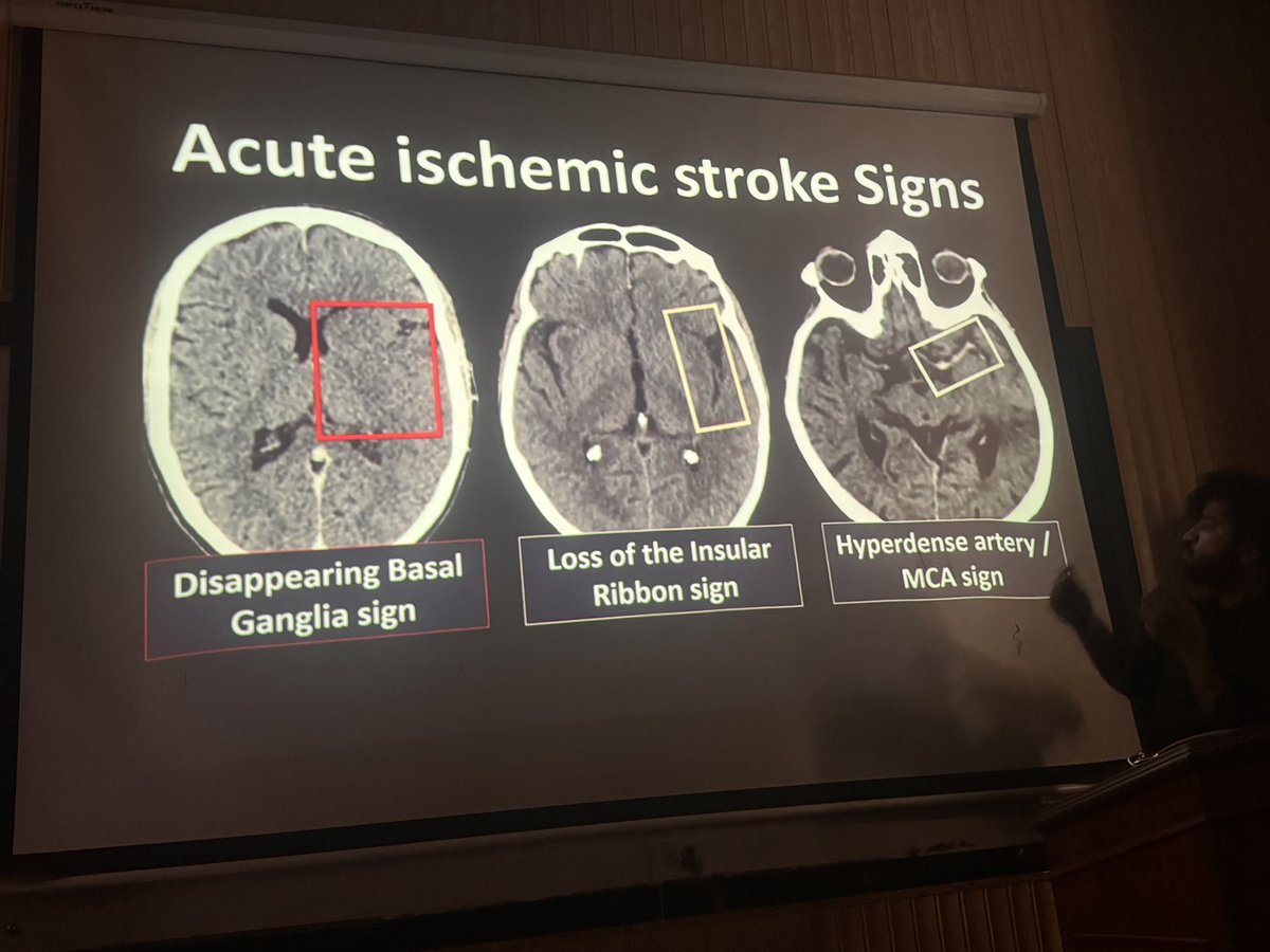 DrMShujat's tweet photo. If you’re a HO / MO / Resident starting Emergency duty. This Slide is GOLD for you. 

In ER, we’re taught “CT is normal in early stroke”. That’s half true.  
If you know these 3 signs, you can spot an acute MCA stroke in <2 minutes on NCCT. https://t.co/AJdFBuANWo