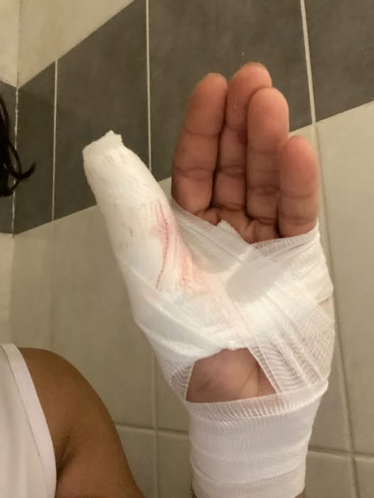 BRINDILLE851's tweet photo. Soyez très prudents si vous vous promenez sur les quais de Loire la nuit.
Mardi soir, vers 23h50, j’ai été agressé sur le quai de Loire par trois individus cagoulés d’origine africaine.
Je rentrais à pied avec ma trottinette, qui n’avait plus de batterie. J’étais en train d’utiliser mon téléphone lorsque les trois personnes se sont approchées. L’un d’eux était armé d’un couteau et m’a demandé mon téléphone. J’ai immédiatement remis mon téléphone dans ma poche et j’ai reculé de quelques pas.
L’individu armé s’est avancé vers moi pendant que les deux autres sont partis avec ma trottinette. J’ai réussi à saisir la main qui tenait le couteau, mais je me suis coupé au pouce et à un doigt. Une bagarre a alors éclaté au sol. Il a essayé de m’étrangler, mais j’ai réussi à me défendre. Il a appelé ses deux complices à l’aide, mais ils ne sont pas revenus. Finalement, il a pris la fuite.
J’ai réussi à conserver mon téléphone, mais j’ai été blessé aux doigts. J’ai immédiatement appelé la police, qui est arrivée rapidement, mais les agresseurs étaient déjà partis et n’ont pas été retrouvés.
Je partage ce message uniquement pour prévenir les autres. Faites très attention si vous circulez à pied sur les quais de Loire, surtout tard le soir. Évitez d’utiliser votre téléphone en marchant et restez vigilants.
