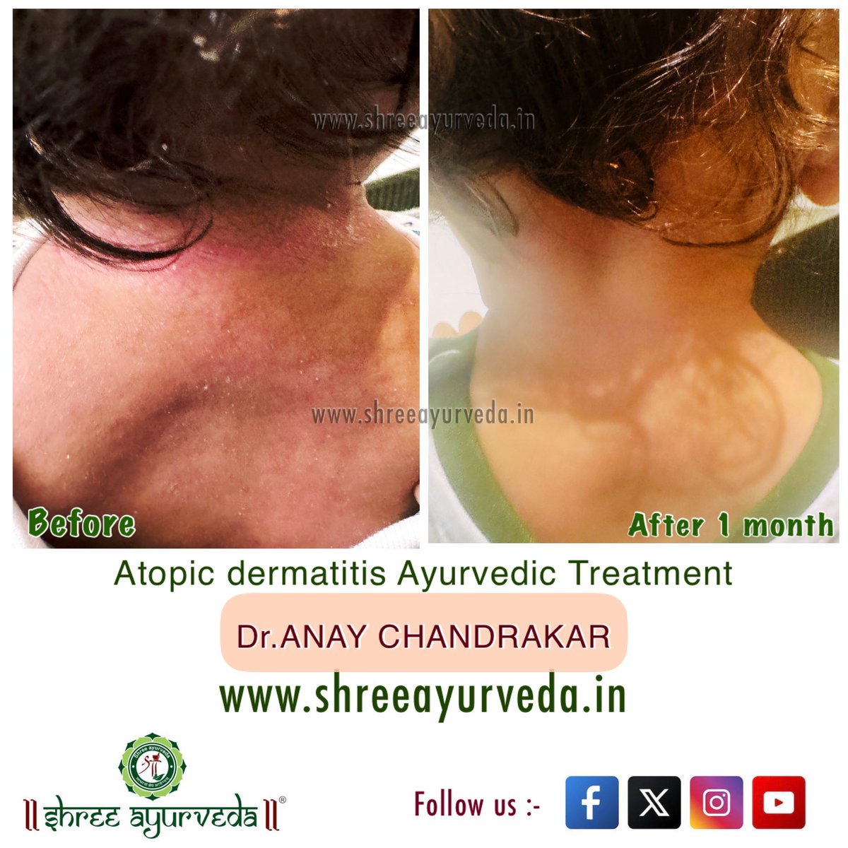 anay_009's tweet photo. At Shree Ayurveda, we focus on treating the root cause through:
🌿 Personalized Ayurvedic medicines
🥗 Diet &amp; lifestyle guidance
🧴 Skin care recommendations
👨‍⚕️ Individualized treatment based on Prakriti and disease stage

#atopicdermatitis #shreeayurvedaraipur https://t.co/w6c4FYyBwj