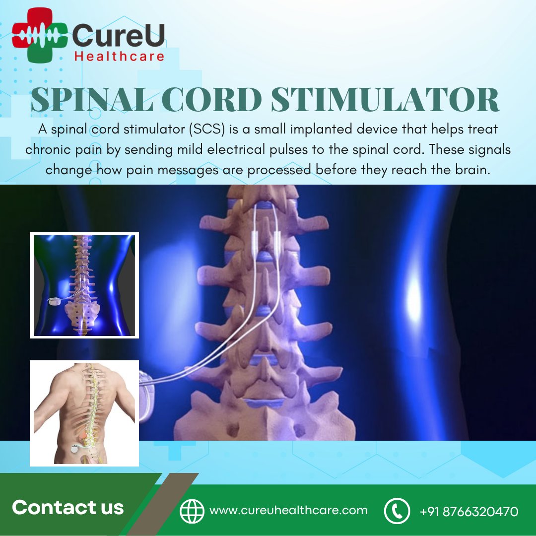 cureU_official's tweet photo. 𝐒𝐩𝐢𝐧𝐚𝐥 𝐂𝐨𝐫𝐝 𝐒𝐭𝐢𝐦𝐮𝐥𝐚𝐭𝐨𝐫

A spinal cord stimulator (SCS) is a small implanted device that helps treat chronic pain by sending mild electrical pulses to the spinal cord. 

#cureuhealthcare #treatmentinindia #hospital #neurosurgery https://t.co/yd0q9U3lyk