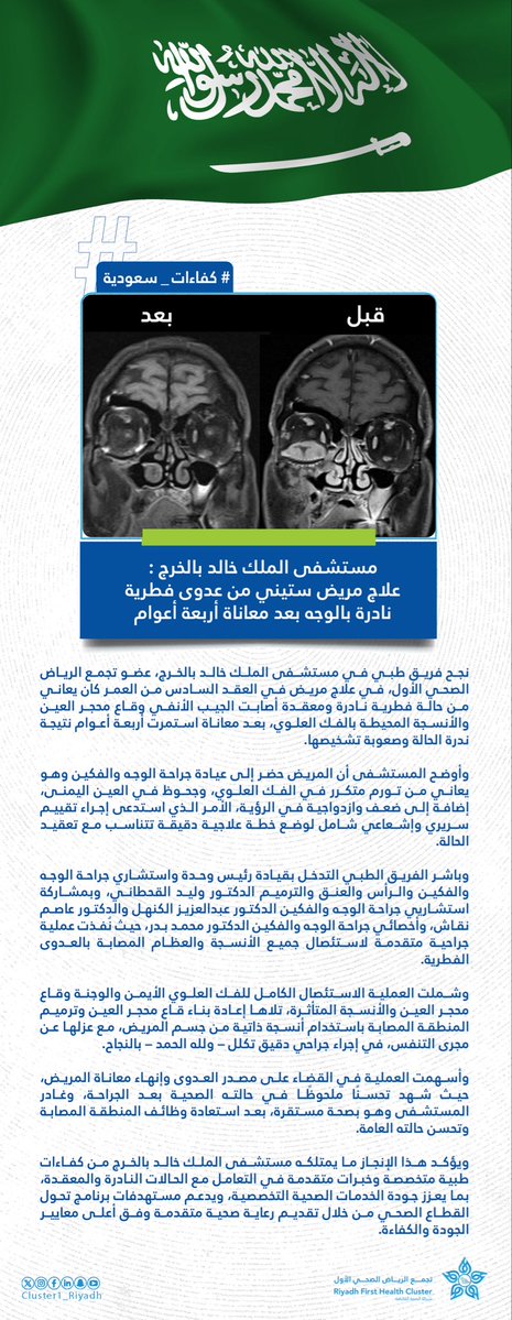 Cluster1_Riyadh's tweet photo. 🗞️| إنهاء معاناة مريض ستيني استمرّت لأربعة أعوام من عدوى فطرية نادرة بالوجه في مستشفى الملك خالد بالخرج عضو  #تجمع_الرياض_الصحي_الأول . https://t.co/fGBMHm1YtO