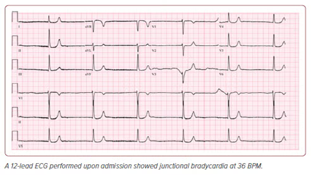 radcliffeCARDIO's tweet photo. 📚 New #JAPSCJournal Article: "BRASH Syndrome: The Lethal Combination of AV Blockers and Hyperkalaemia"

📚 Just Published!

🔓Access it here 👉 https://t.co/dqIsHKre4W

@apsc_office #CVImaging #MedEd #CardioEd #Electrophysiology #Arrhythmia https://t.co/ecNxk7drIS
