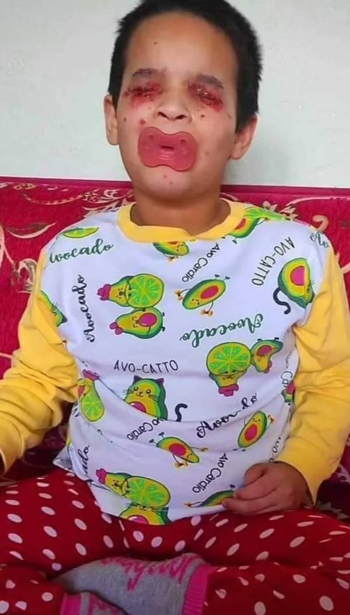 Kimsesizz177's tweet photo. 10 yaşındaki evladım dayanılmaz acılar çekiyor çaresiz durumdayım dayanacak gücümüz kalmadı kimseye sesimizi duyuramadım yalvarıyorum elinizi ayağınızı öpeyim paylaşım ve yardımınıza ihtiyacım var kızımın gözlerinde yoğun kanama oluşuyor acilen gözlerine top mercekler takılması gerekiyor maddi imkanım yok sağlık sorunlarım olduğu için çalışamıyorum iş bulamıyorum 6 ay oldu kiramı veremiyorum ev sahibi 1 hafta süre verdi engelli evladım ile ortada kaldık yalvarıyorum yardımınıza ihtiyacım var 
TR64 0011 1000 0000 0119 2315 62
EMRAH ÖNAL