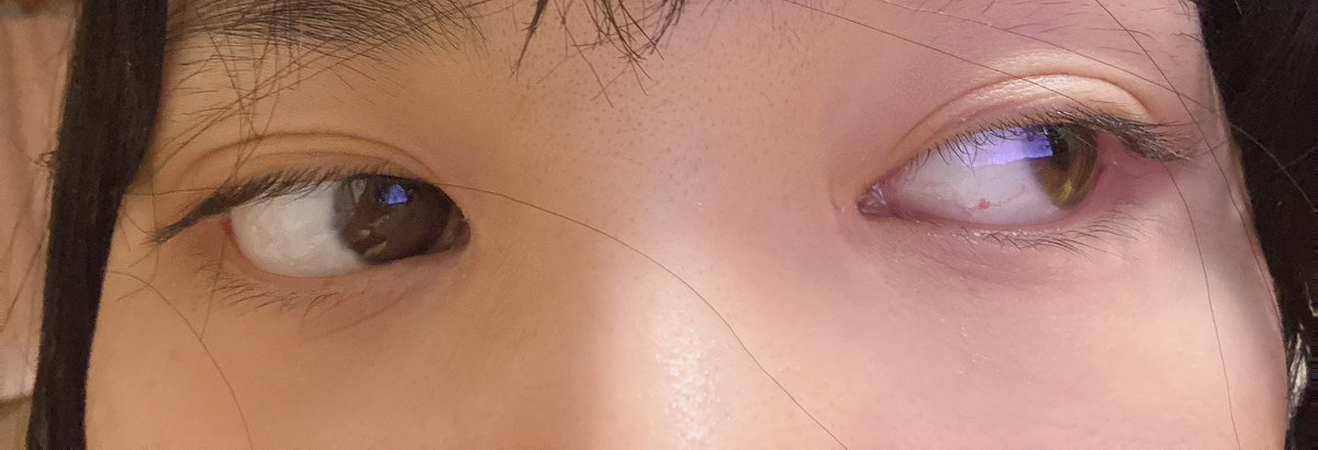 kitty_chan0722's tweet photo. S南千葉院医院長です。
私はぴったり時間に着きましたが、1時間遅れました。
目頭切開を、右目は切れているため残すか悩みに入りましたが、両方切られました
左目は丸く切られ、7/10まで医師不在で待たされています。 https://t.co/rgHYcPocF0