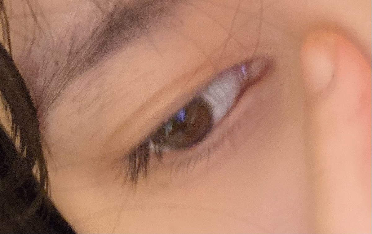kitty_chan0722's tweet photo. S南千葉院医院長です。
私はぴったり時間に着きましたが、1時間遅れました。
目頭切開を、右目は切れているため残すか悩みに入りましたが、両方切られました
左目は丸く切られ、7/10まで医師不在で待たされています。 https://t.co/rgHYcPocF0