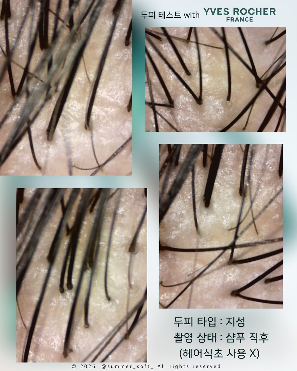 summer_soft_'s tweet photo. #광고 @yvesrocherkorea 
RT추첨 다섯 분께 지성두피 전용 이브로쉐 알개 퓨리파잉 헤어식초를 보내드릴게요💚

여름이 괴로운 지성 분들🥹 샴푸해도 냄새 및 기름기 때문에 개운함이 아쉬웠던 분들 .ᐟ 
지성 두피용 헤어식초 써보면 어떠신지 ✨

저는 헤어식초라는 제품을 오직 이브로쉐에서만 판매하던 때부터 사용해왔어요. (당연히 내돈내산으로 써봄) 그땐 정말 생소했는데, 이젠 두피 케어 필수템이 된 거 같음 .ᐟ  .ᐟ 
여름에도 두피 떡짐 없이 하루종일 뽀송하다는 후기들 보고 넘나 궁금했는데, 오늘부터 일주일간 매일 써보고 변화를 체험해보고자 해요!

비포 두피부터 공유드립니다 >.< (샴푸만 했을 때)

일주일 후, 제가 체감한 것들 공유드릴게요🫡🫶🏻